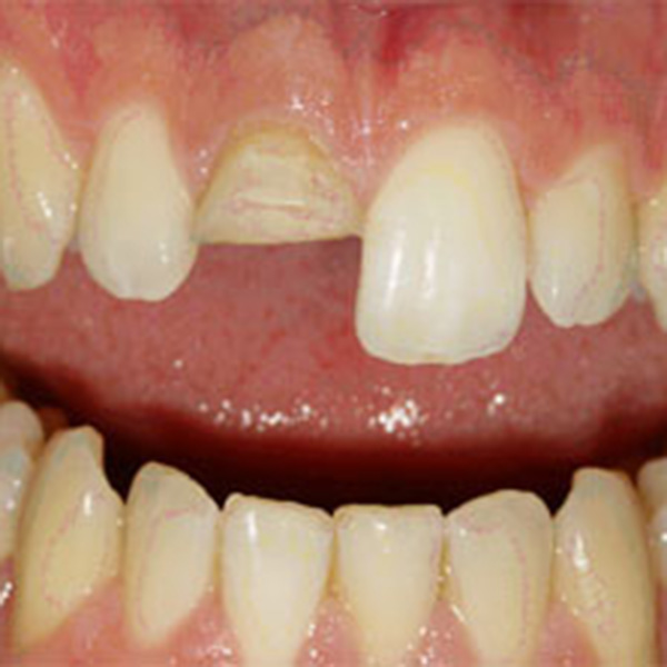 Protesi dentali