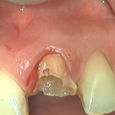 Frattura corona dentale