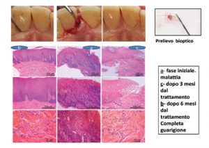 guarigione parodontite ascesso epifluorescenza