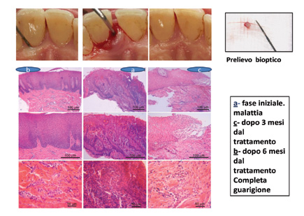 Fase di guarigione parodontologia