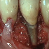 Frattura radice impianto dentale