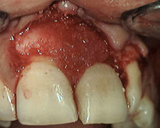 Rigenerazione tessuto con biomateriale